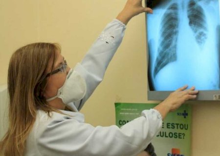 Conselho aprova novas diretrizes para tratamento da tuberculose no SUS