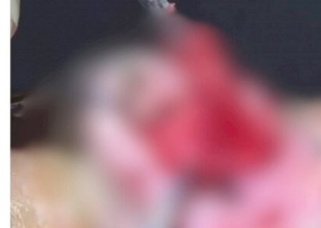 Dentista faz rinoplastia, provoca necrose em cliente e acaba procurada pela polícia em Campo Grande