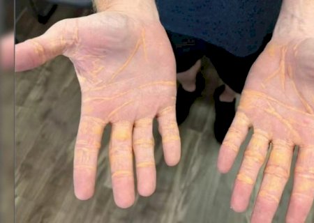 Dieta carnívora faz homem ‘vazar’ colesterol pela mão nos EUA