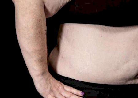 M&eacute;dicas e nutricionistas v&atilde;o falar sobre lipedema em evento gratuito na Capital