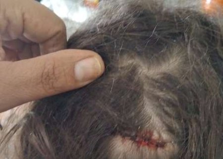 Menina de 7 anos &eacute; atingida na cabe&ccedil;a por bala perdida enquanto dormia em casa