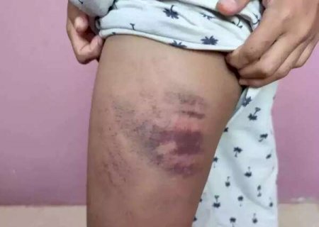 Investiga&ccedil;&atilde;o conclui que m&atilde;e agrediu filho autista e culpou colega de escola